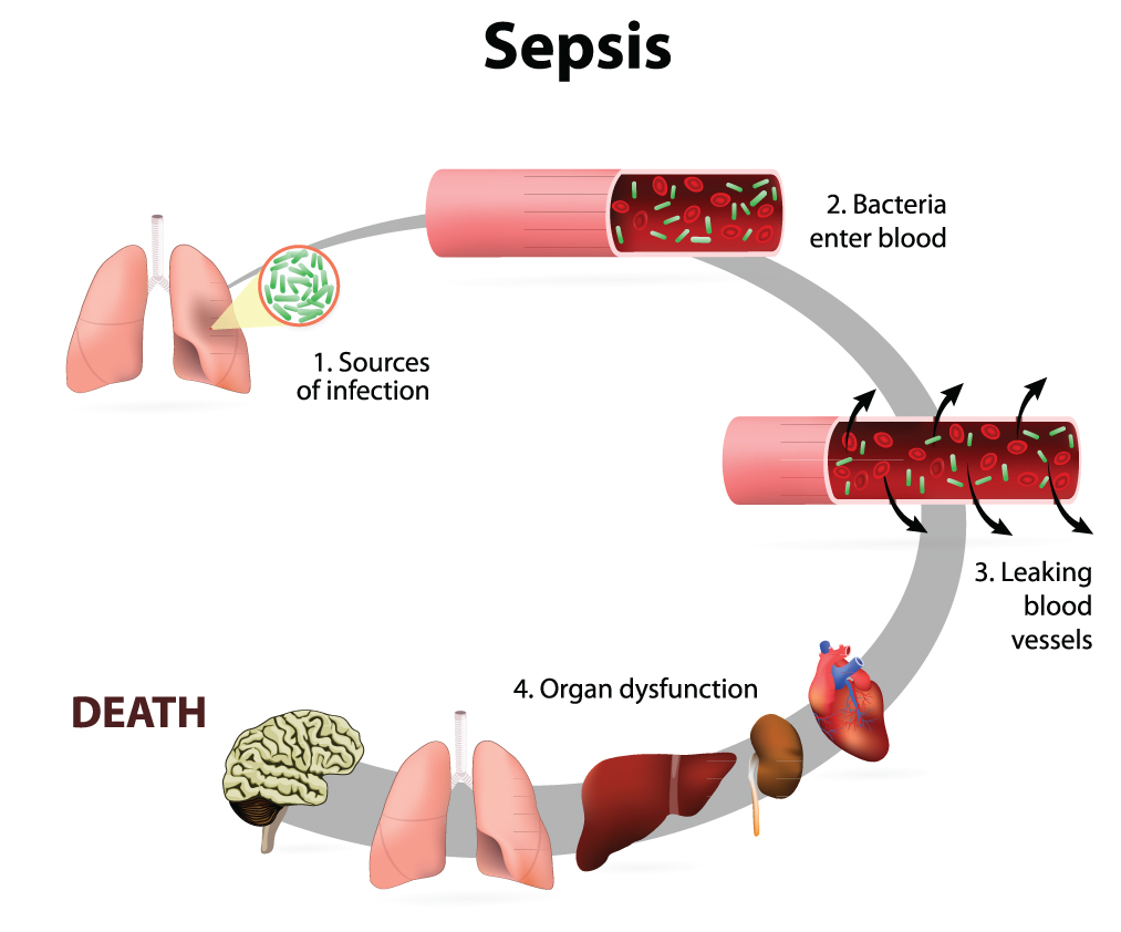 The Laboratory S Role In Combating Sepsis Medical Laboratory Observer
