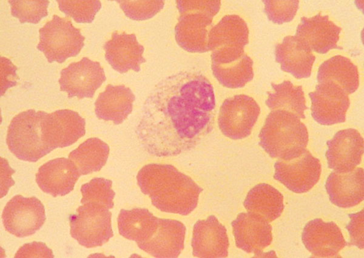 Edta In Transit Degenerative Changes In Blood Cell Morphology Medical Laboratory Observer