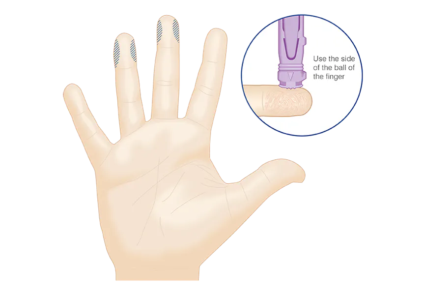 Capillary sampling for HbA1c testing | Medical Laboratory Observer