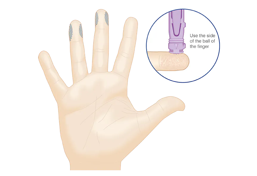 Fingertip Sampling Capillary sampling for HbA1c testing | Medical Laboratory Observer