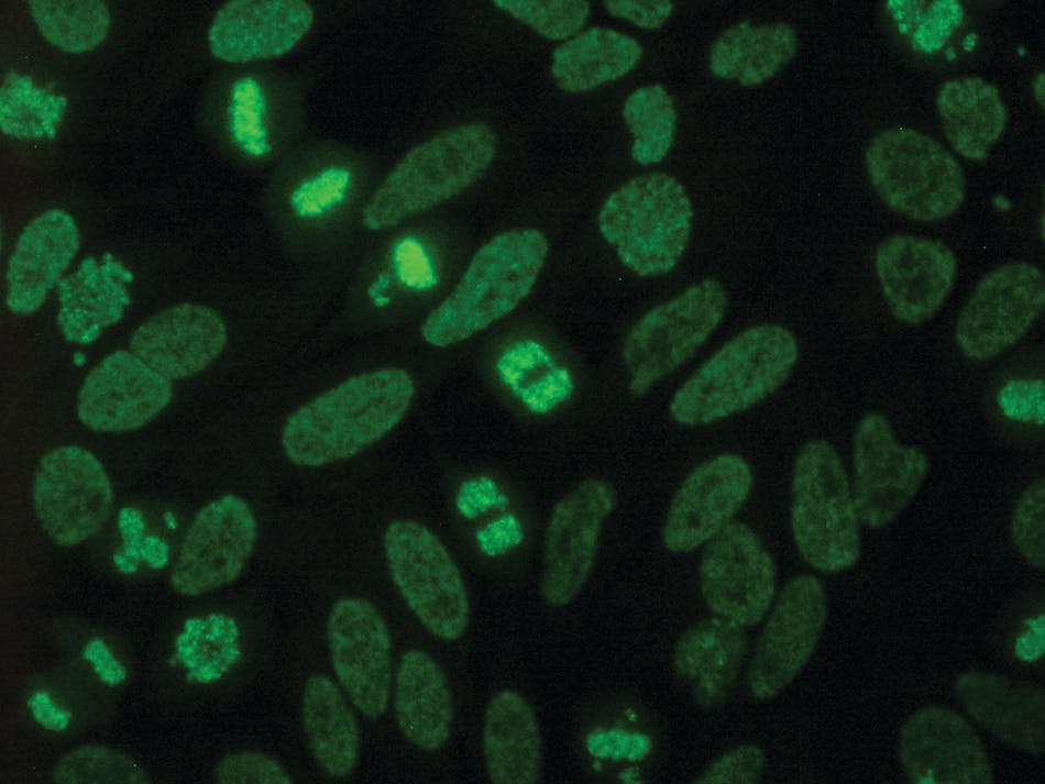 Dense fine speckled (DFS, AC-2) indirect immunofluorescence staining on HEp2 cells. Image courtesy of EUROIMMUN.