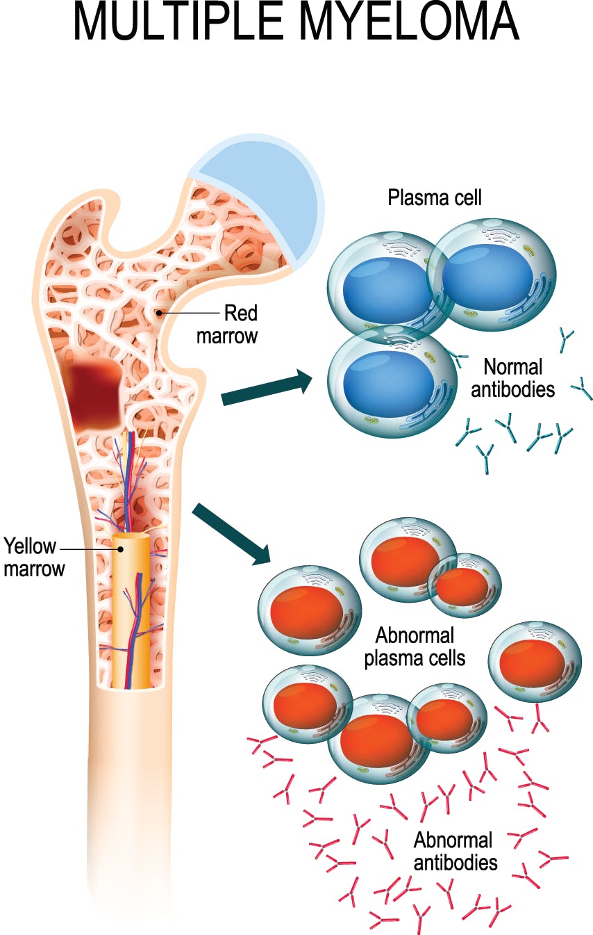 Figure 1. Representation of the overproduction of plasma cells in the bone marrow in multiple myeloma (MM) that produce high levels of monoclonal immunoglobulin (M protein)