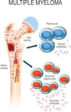 Figure 1. Representation of the overproduction of plasma cells in the bone marrow in multiple myeloma (MM) that produce high levels of monoclonal immunoglobulin (M protein) Figure 1. Representation of the overproduction of plasma cells in the bone marrow in multiple myeloma (MM) that produce high levels of monoclonal immunoglobulin (M protein)