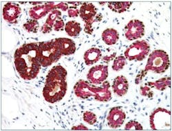 Figure 1. Multiplex IHC - Normal Breast Stained with CK5, CK14, p63, CK7, and CK18 antibodies. Breast basal cells express cytokeratins 5 and 14 (DAB; brown), myoepithelial cells express those same cytokeratins along with p63 (DAB; brown), and luminal cells express cytokeratins 7 and 18 (red).7 Figure 1. Multiplex IHC - Normal Breast Stained with CK5, CK14, p63, CK7, and CK18 antibodies. Breast basal cells express cytokeratins 5 and 14 (DAB; brown), myoepithelial cells express those same cytokeratins along with p63 (DAB; brown), and luminal cells express cytokeratins 7 and 18 (red).7