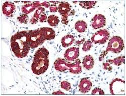 Figure 1. Multiplex IHC - Normal Breast Stained with CK5, CK14, p63, CK7, and CK18 antibodies. Breast basal cells express cytokeratins 5 and 14 (DAB; brown), myoepithelial cells express those same cytokeratins along with p63 (DAB; brown), and luminal cells express cytokeratins 7 and 18 (red).7 Figure 1. Multiplex IHC - Normal Breast Stained with CK5, CK14, p63, CK7, and CK18 antibodies. Breast basal cells express cytokeratins 5 and 14 (DAB; brown), myoepithelial cells express those same cytokeratins along with p63 (DAB; brown), and luminal cells express cytokeratins 7 and 18 (red).7