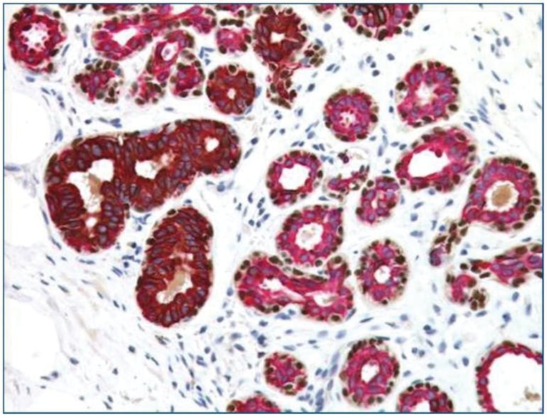 Figure 1. Multiplex IHC - Normal Breast Stained with CK5, CK14, p63, CK7, and CK18 antibodies. Breast basal cells express cytokeratins 5 and 14 (DAB; brown), myoepithelial cells express those same cytokeratins along with p63 (DAB; brown), and luminal cells express cytokeratins 7 and 18 (red).7