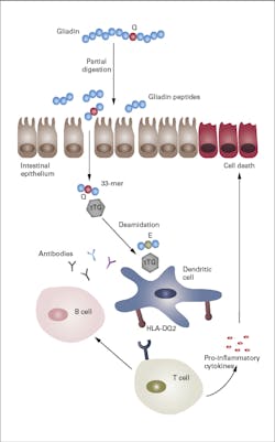Pathogenesis of celiac disease. Pathogenesis of celiac disease.