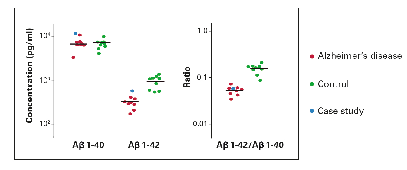 Figure 2. Case example of beta amyloid ratio calculation (Internal study)
