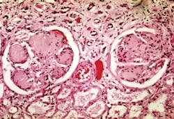 This photomicrograph from the CDC depicts some of the histopathologic details seen in a kidney tissue sample, in a case of nodular glomerulosclerosis, otherwise known as Kimmelstiel-Wilson syndrome, which is a form of diabetic nephropathy, associated with long-standing diabetes mellitus. This photomicrograph from the CDC depicts some of the histopathologic details seen in a kidney tissue sample, in a case of nodular glomerulosclerosis, otherwise known as Kimmelstiel-Wilson syndrome, which is a form of diabetic nephropathy, associated with long-standing diabetes mellitus.