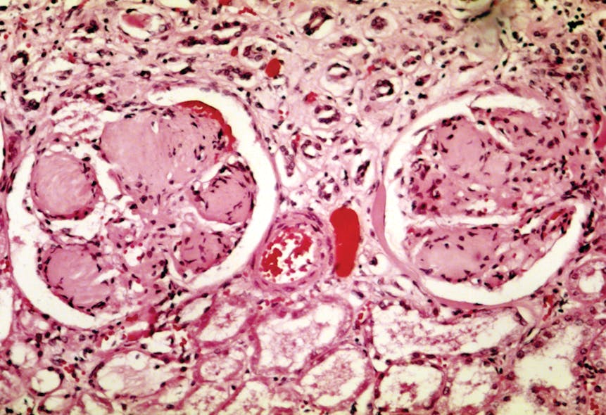This photomicrograph from the CDC depicts some of the histopathologic details seen in a kidney tissue sample, in a case of nodular glomerulosclerosis, otherwise known as Kimmelstiel-Wilson syndrome, which is a form of diabetic nephropathy, associated with long-standing diabetes mellitus.