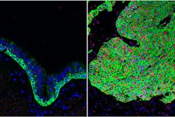 Normal airway tissue, left, and lung cancer tissue, right, with an overabundance of basal stem cells (green). The activated form of beta-catenin (red) in the lung cancer can be targeted by the Wnt Inhibitor Compound 1. Normal airway tissue, left, and lung cancer tissue, right, with an overabundance of basal stem cells (green). The activated form of beta-catenin (red) in the lung cancer can be targeted by the Wnt Inhibitor Compound 1.
