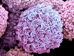 Colored scanning electron micrograph (SEM) of breast cancer cells. Image courtesy of Steve Gschmeissner/SPL Colored scanning electron micrograph (SEM) of breast cancer cells. Image courtesy of Steve Gschmeissner/SPL