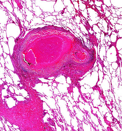 Stained human lung tissue from a patient who was on anti-tuberculous therapy and underwent emergency pneumonectomy for massive airway bleeding.