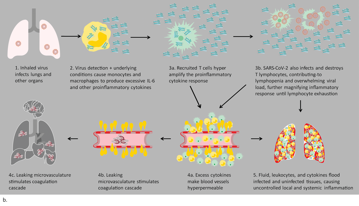 Covid 19 And Cytokine Storm Syndrome Medical Laboratory Observer Covid 19 And Cytokine Storm Syndrome Medical Laboratory Observer