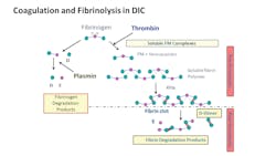 Coagulation and fibrinolysis in disseminated intravascular coagulation (DIC), specifically showing fibrin degradation product (FDP), fibrin monomer (FM), and D-dimer development before and after VTE occurrence, along with the formation of D and E fragments.