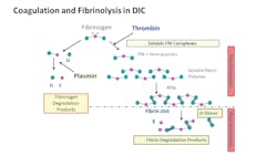Coagulation and fibrinolysis in disseminated intravascular coagulation (DIC), specifically showing fibrin degradation product (FDP), fibrin monomer (FM), and D-dimer development before and after VTE occurrence, along with the formation of D and E fragments. Coagulation and fibrinolysis in disseminated intravascular coagulation (DIC), specifically showing fibrin degradation product (FDP), fibrin monomer (FM), and D-dimer development before and after VTE occurrence, along with the formation of D and E fragments.
