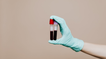 Capillary Sampling For Hba1c Testing Medical Laboratory Observer