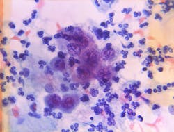 Cdc Cancer Cells 19471 1 5ed504a66c7bc Cdc Cancer Cells 19471 1 5ed504a66c7bc