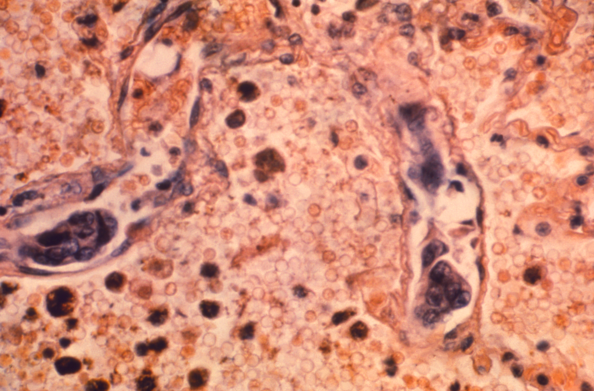 Cdc Cancer Cells 22244 5ef35131ec3b0