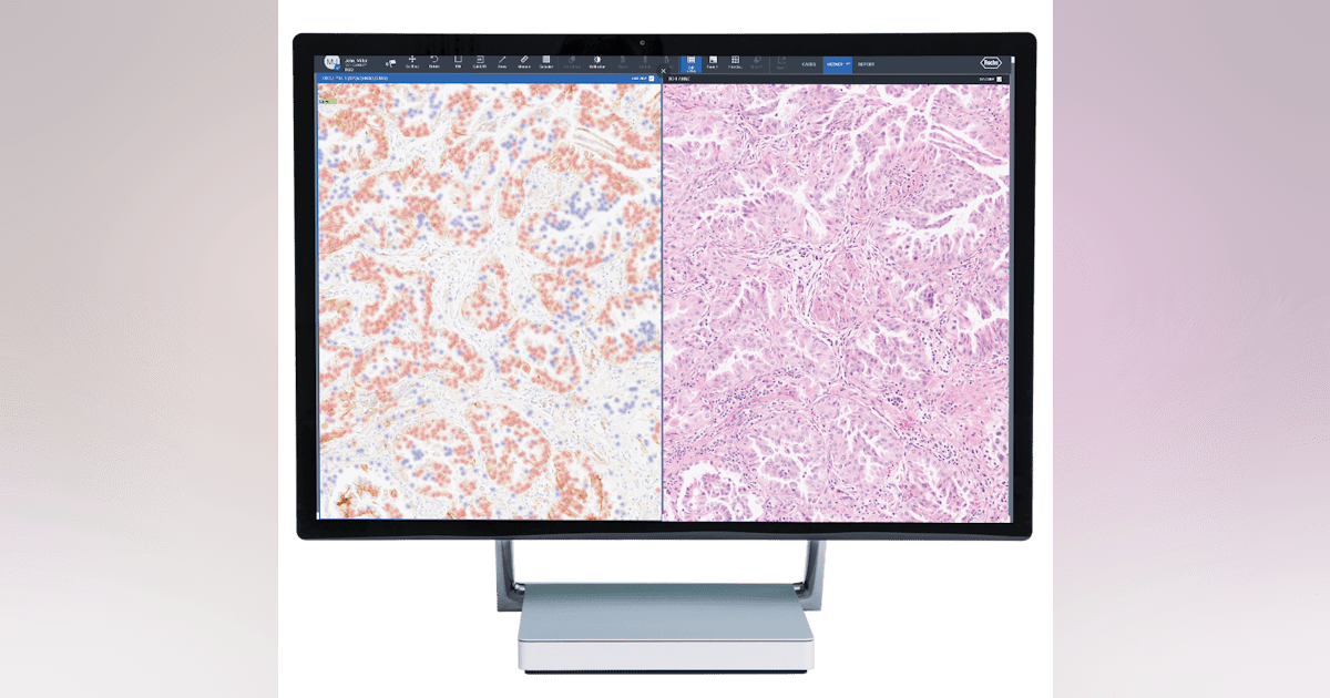Roche launches digital pathology algorithm for non-small cell lung ...