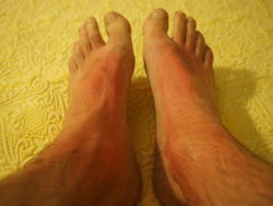 Pixabay Sunburn 1522091 1280 5f241c5e91fac Pixabay Sunburn 1522091 1280 5f241c5e91fac