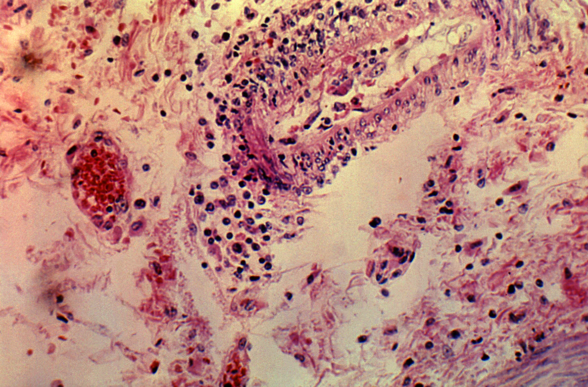 FDA Approves Drug To Treat Group Of Rare Blood Disorders Medical Fda approves drug to treat group of rare blood disorders medical