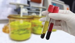 Hemolysis can affect the measurement results of specific analytes significantly