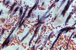 A lung tissue specimen from the Centers for Disease Control and Prevention shows darkly stained filaments of an Aspergillus sp. fungal organism, in a case of aspergillosis. A lung tissue specimen from the Centers for Disease Control and Prevention shows darkly stained filaments of an Aspergillus sp. fungal organism, in a case of aspergillosis.