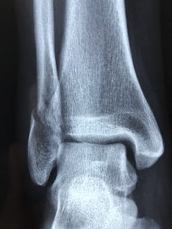 Pixabay ankle 2 22 21 60334f519c87f Pixabay ankle 2 22 21 60334f519c87f