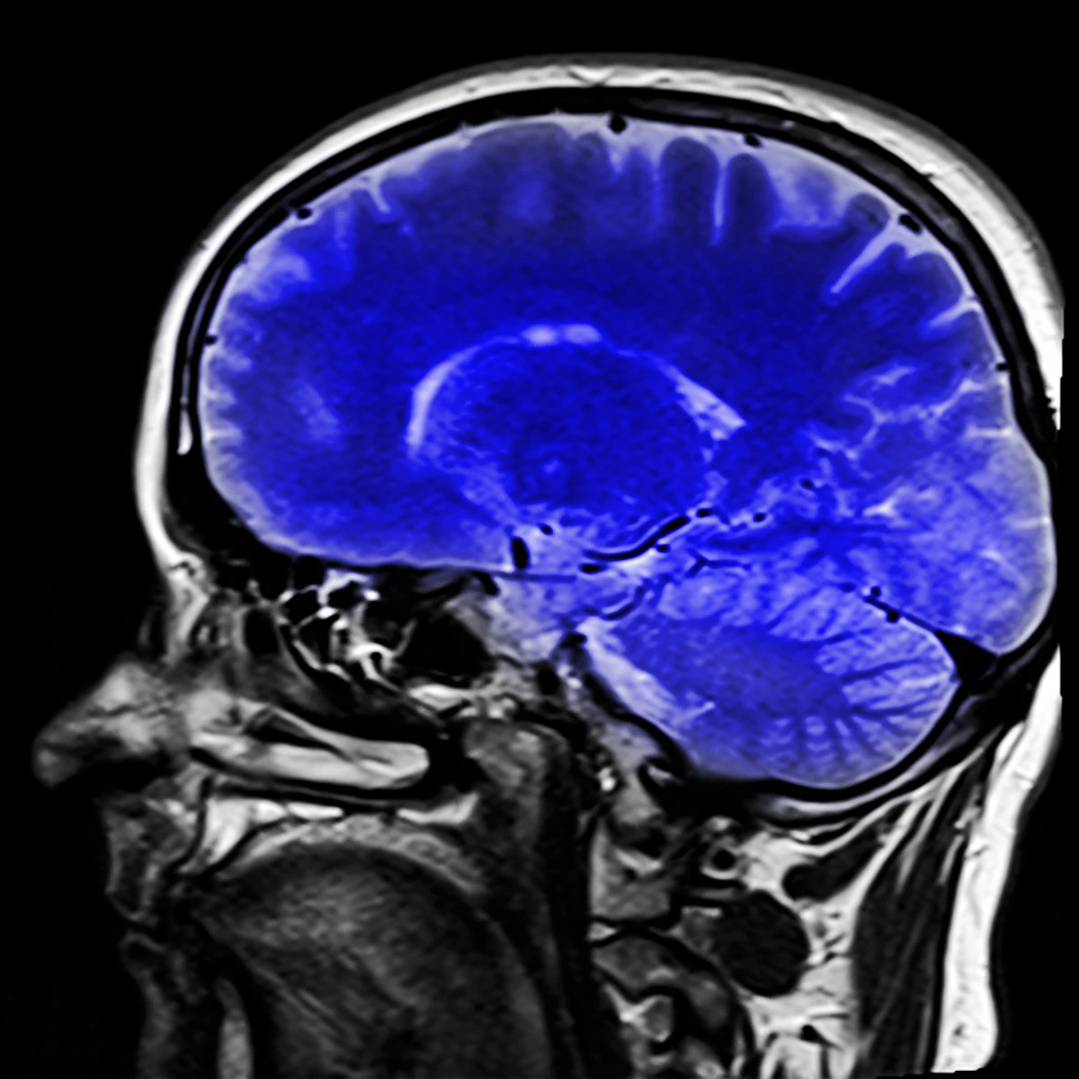 Recurrent GBM Brain Tumors With Few Mutations Respond Best To 