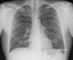 Pixabay lung 2 16 21 602bc73851004 Pixabay lung 2 16 21 602bc73851004