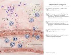 Inflammation During Cdi Mlo 6054ed9227c65 Inflammation During Cdi Mlo 6054ed9227c65