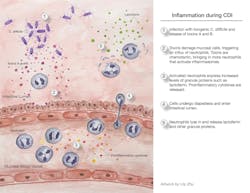 Inflammation During Cdi Mlo