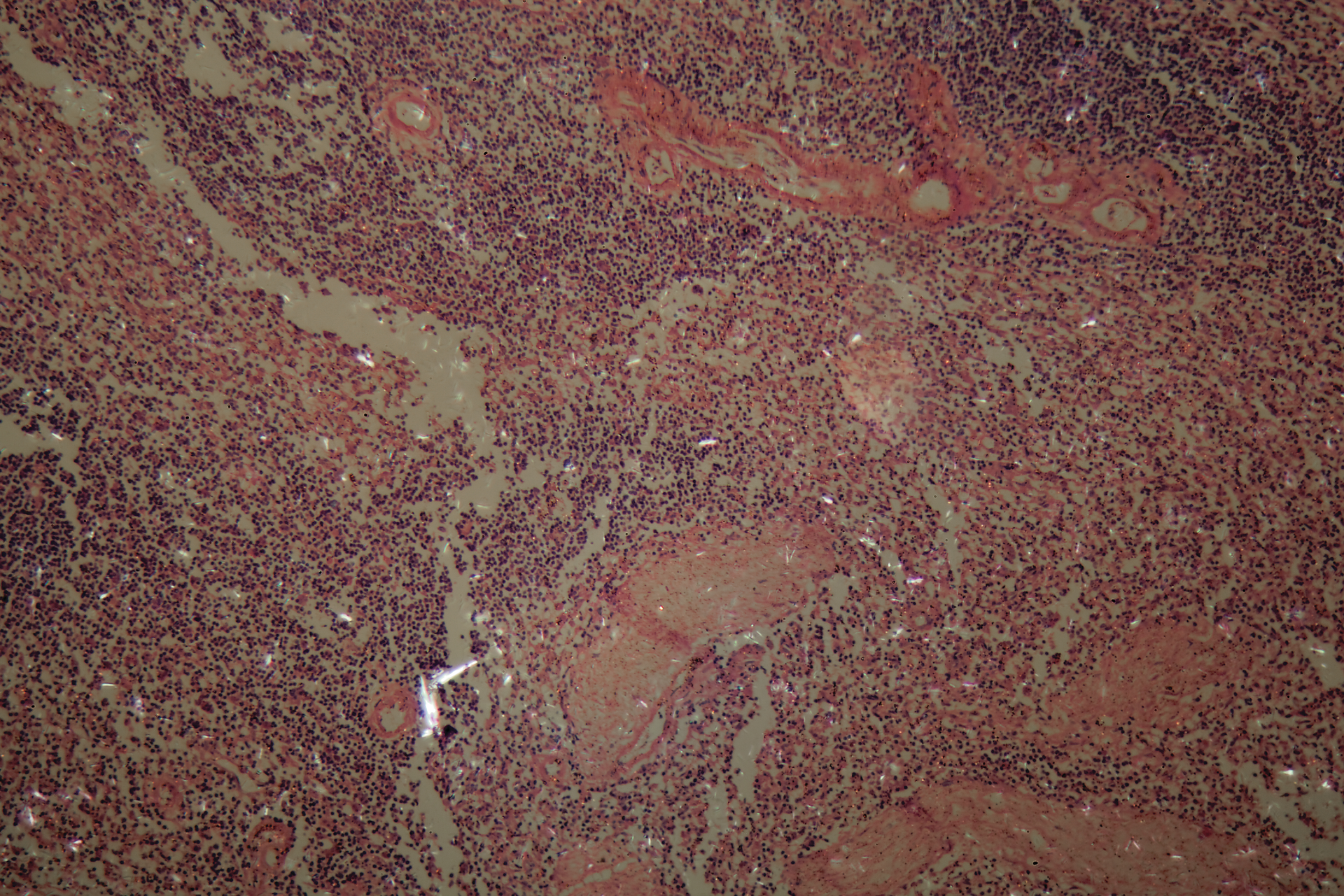 Cells of a human ovary with Ovarian cancer cells under the microscope.