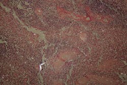 Cells of a human ovary with Ovarian cancer cells under the microscope. Cells of a human ovary with Ovarian cancer cells under the microscope.