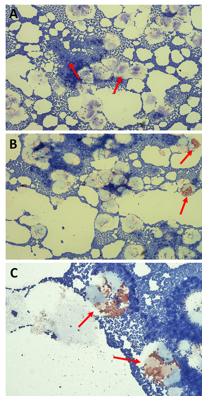 Figure 1. CSF Wright-Giemsa stain of our patient, a 27-day-old female infant with severe LOD-GBS. A: Moderate degenerated WBCs (presumably PMNs) and an overwhelming number of GPC, suggesting advanced sepsis (original magnification 500x). B: Rare to few semi-intact eosinophils, distinguished by their large, red, acidophilic granules (original magnification 500x). C: Degenerated eosinophils with cytoplasmic contents, but with no apparent cytoplasm (original magnification 1000x).
