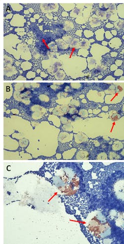 Figure 1. CSF Wright-Giemsa stain of our patient, a 27-day-old female infant with severe LOD-GBS. A: Moderate degenerated WBCs (presumably PMNs) and an overwhelming number of GPC, suggesting advanced sepsis (original magnification 500x). B: Rare to few semi-intact eosinophils, distinguished by their large, red, acidophilic granules (original magnification 500x). C: Degenerated eosinophils with cytoplasmic contents, but with no apparent cytoplasm (original magnification 1000x). Figure 1. CSF Wright-Giemsa stain of our patient, a 27-day-old female infant with severe LOD-GBS. A: Moderate degenerated WBCs (presumably PMNs) and an overwhelming number of GPC, suggesting advanced sepsis (original magnification 500x). B: Rare to few semi-intact eosinophils, distinguished by their large, red, acidophilic granules (original magnification 500x). C: Degenerated eosinophils with cytoplasmic contents, but with no apparent cytoplasm (original magnification 1000x).