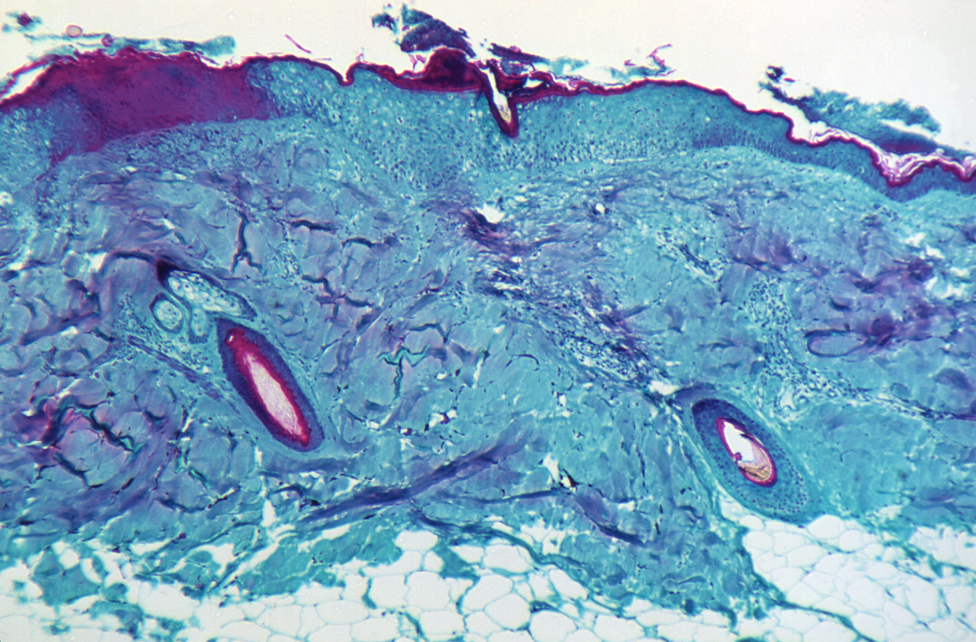 Monkeypox Courtesy Cdc 60f5701348ad9