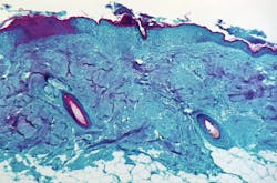 Monkeypox Courtesy Cdc 60f5701348ad9 Monkeypox Courtesy Cdc 60f5701348ad9