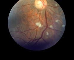 Lupus Retina Courtesy Cdc 6128e17c9d25c Lupus Retina Courtesy Cdc 6128e17c9d25c