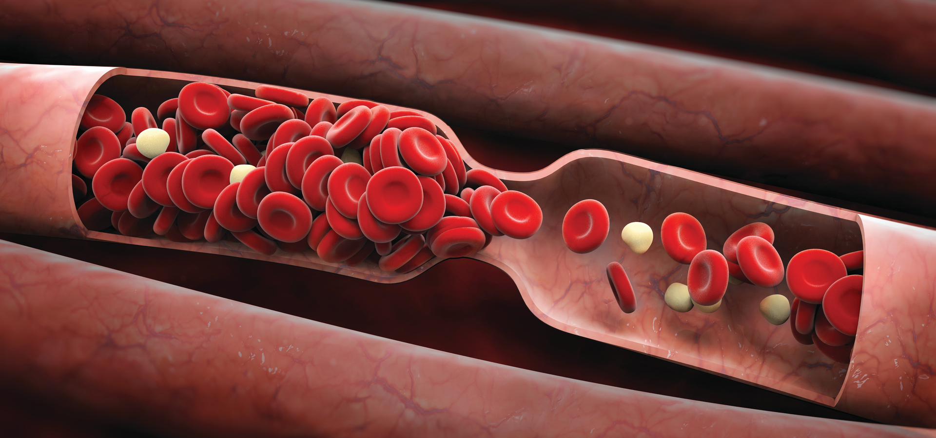 Blood clots can kill A current overview of thrombosis risk factors
