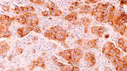 Breast Cancer Ductal Carcinoma Photo By National Cancer Institute On Unsplash