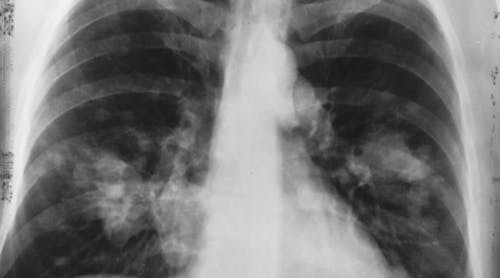 Lung Xray Photo By National Cancer Institute On Unsplash