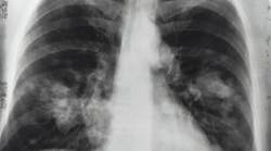 Lung Xray Photo By National Cancer Institute On Unsplash