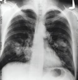 Lung Xray Photo By National Cancer Institute On Unsplash 61795f1dd4e6f Lung Xray Photo By National Cancer Institute On Unsplash 61795f1dd4e6f