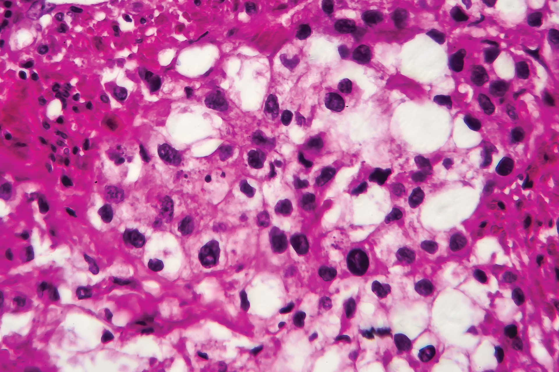 A variety of projects evaluating liquid-based tests are in progress to detect cancer early based on DNA fragments. Bladder cancer, pictured here, is the subject of one such test.