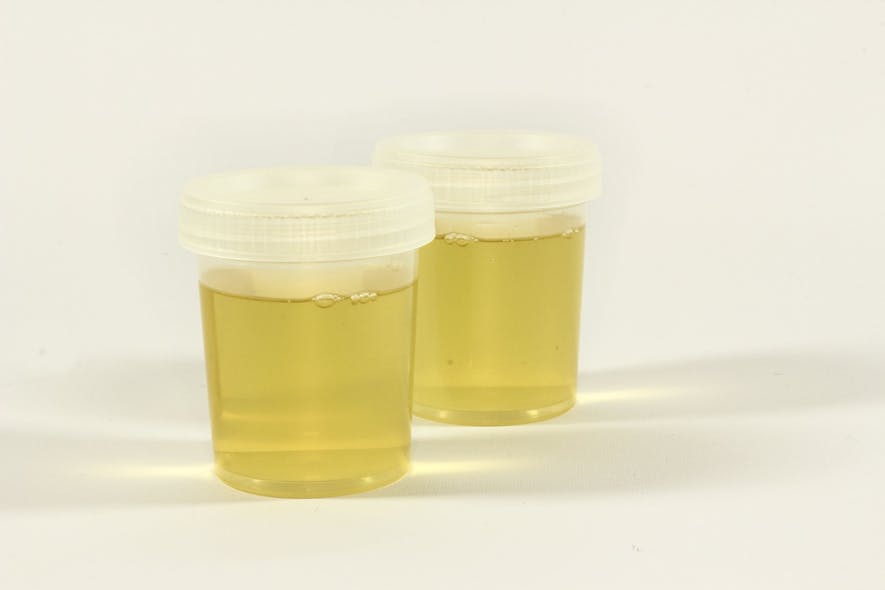 Test detects signs of urothelial cancer using urine test Medical