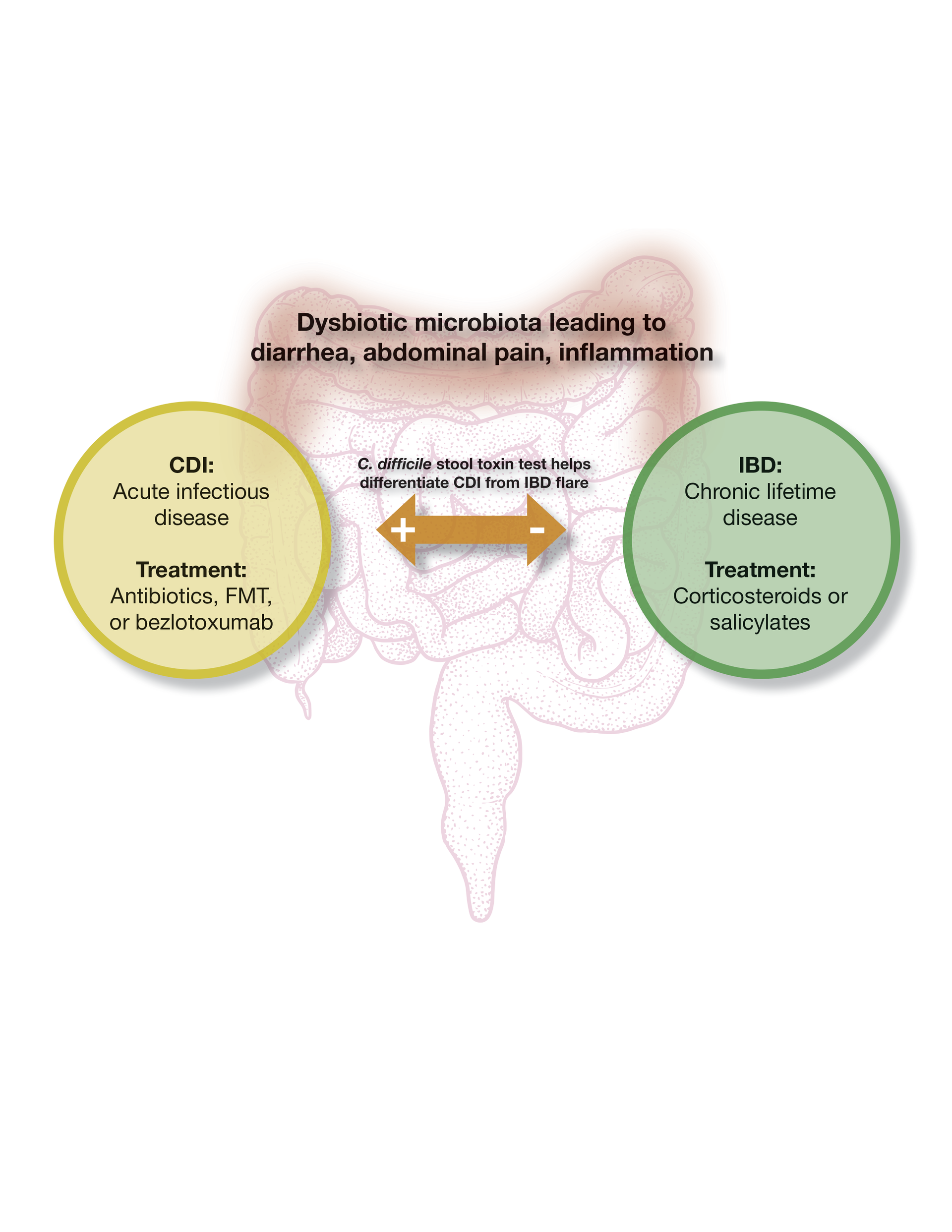 Figure 1. CDI and IBD are two unrelated diseases that are triggered by a dysbiotic intestinal microbiota. The use of a stool toxin test can help identify CDI in a patient with IBD, resulting in appropriate therapy for the infection.