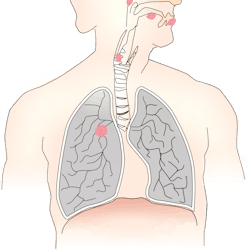 Pixabay Lung Cancer 156101 626be26355936 Pixabay Lung Cancer 156101 626be26355936