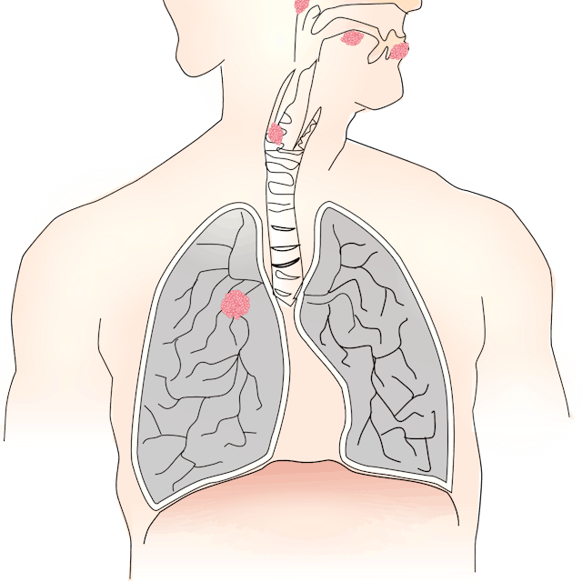Pixabay Lung Cancer 156101